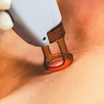 epilation laser prix dermatologue — Epilation laser prix dermatologue : ce qu’il faut prévoir