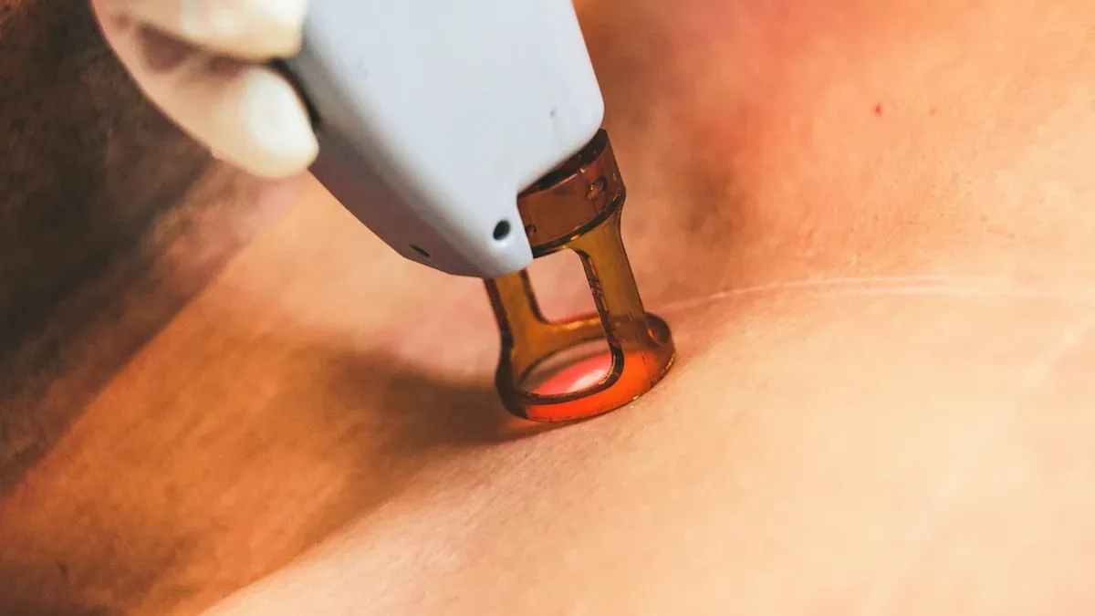 epilation laser prix dermatologue — Epilation laser prix dermatologue : ce qu’il faut prévoir