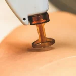 laser fractionne co2 prix — Laser fractionné co2 prix : ce qu’il faut prévoir